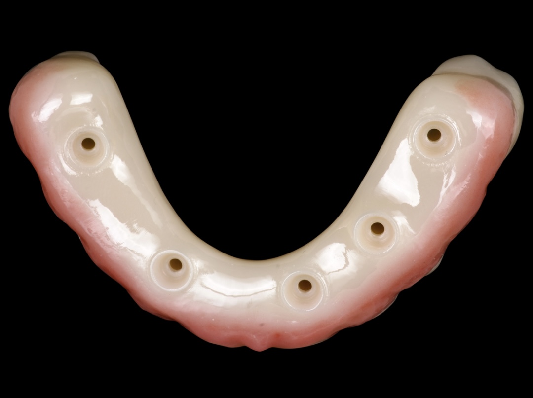 Implant Supported Dentures (All on X)